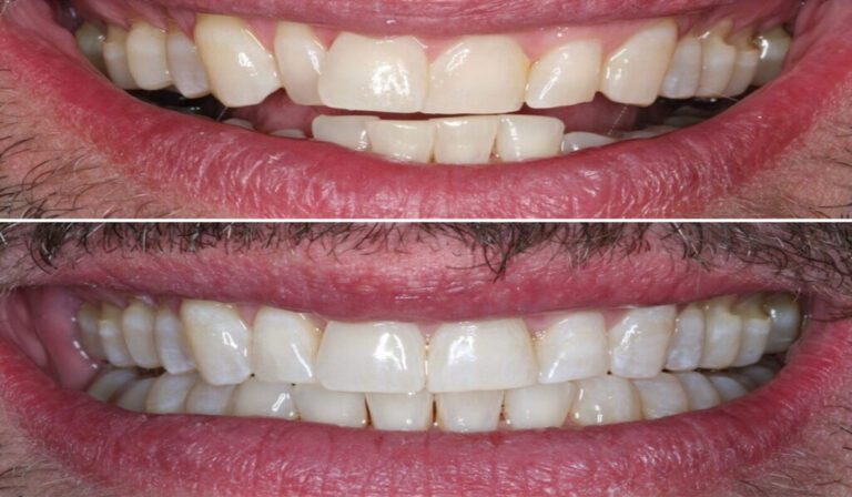 Invisalign: Before And After