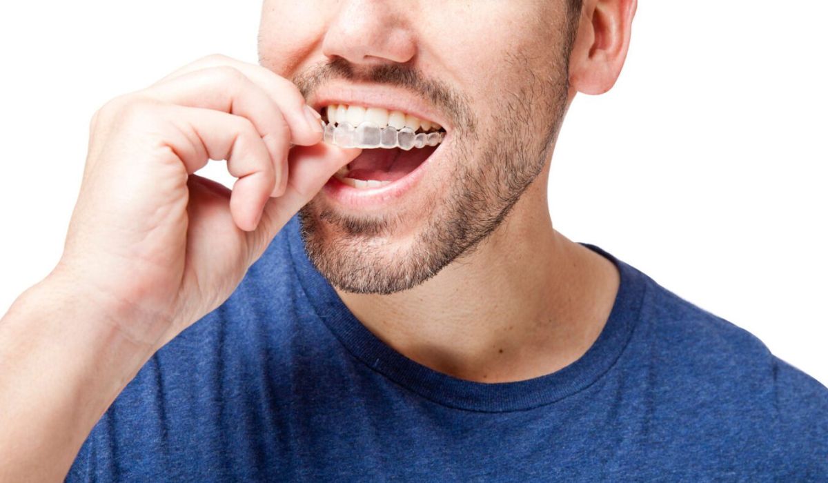 man inserting Invisalign clear braces onto his teeth while wearing a blue shirt