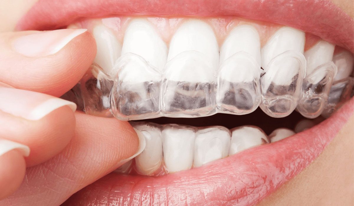 woman inserting invisalign onto her top teeth