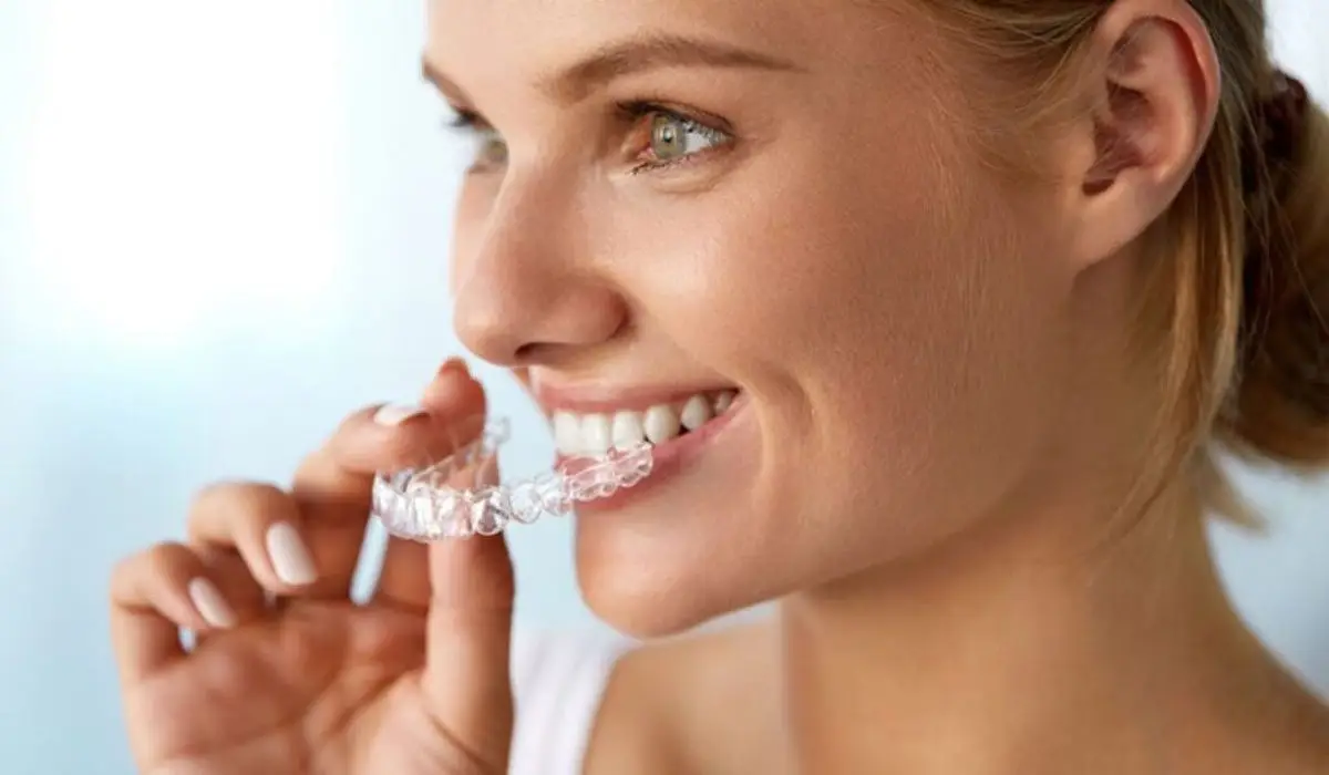 5 Things To Know About Invisalign Braces At Schaumburg Dentistry