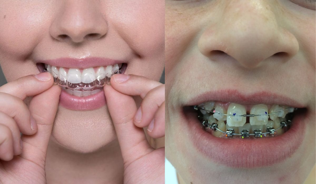 Invisalign Vs. Braces: Differences, Treatment Time And Benefits