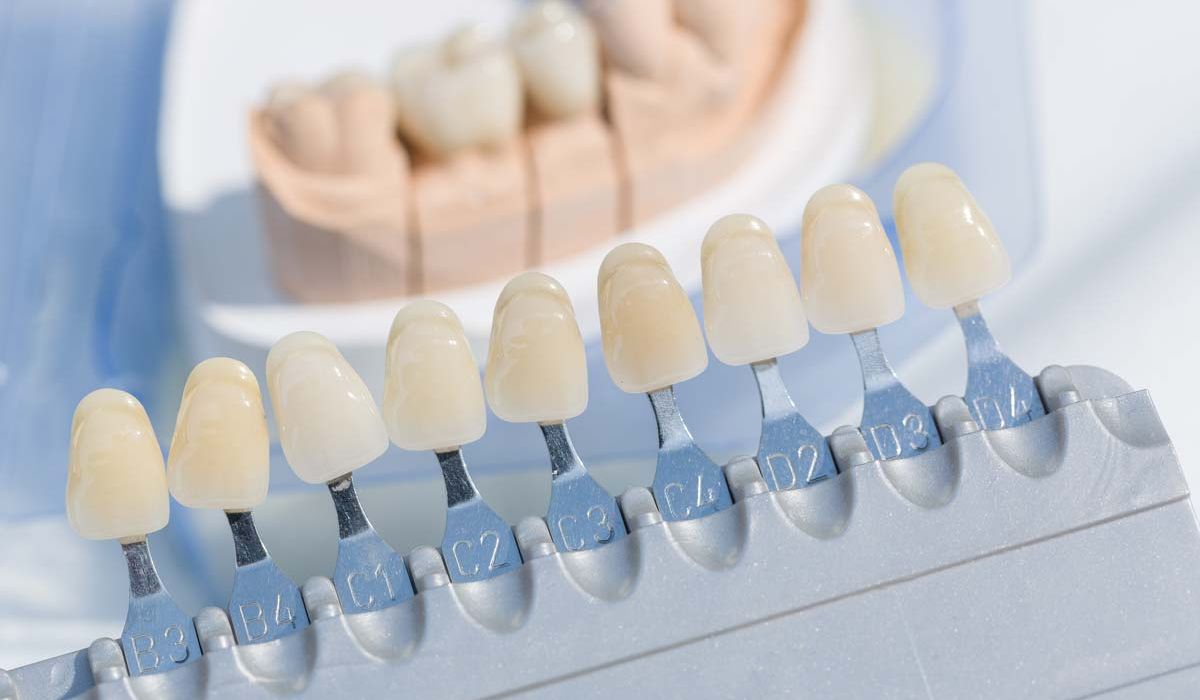 shade selection of dental veneers