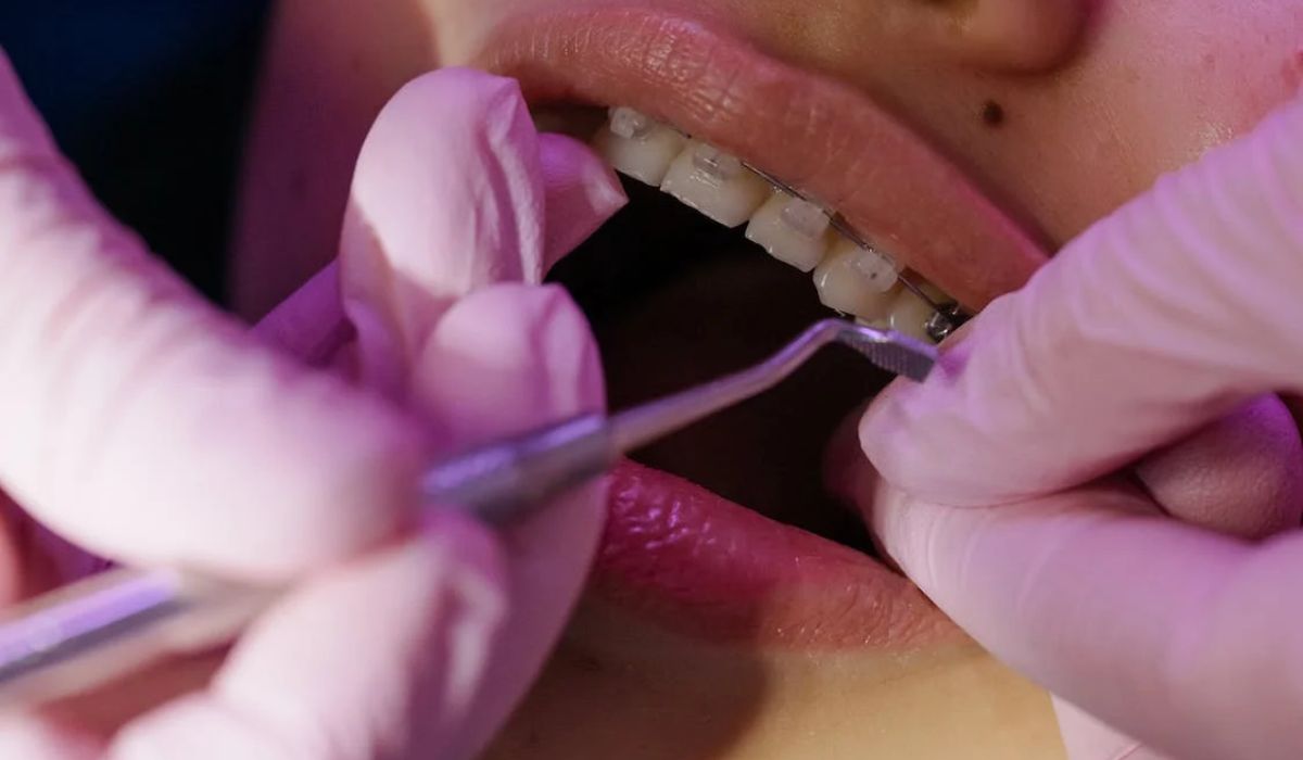 a dentist putting braces on the patient.