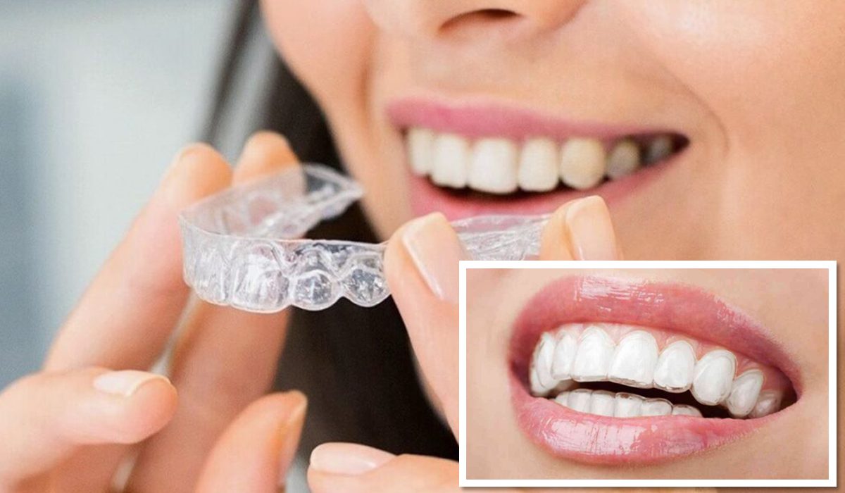 thin clear aligners on woman's teeth
