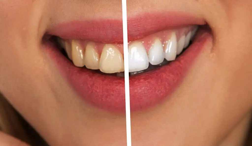 teeth whitening before and after