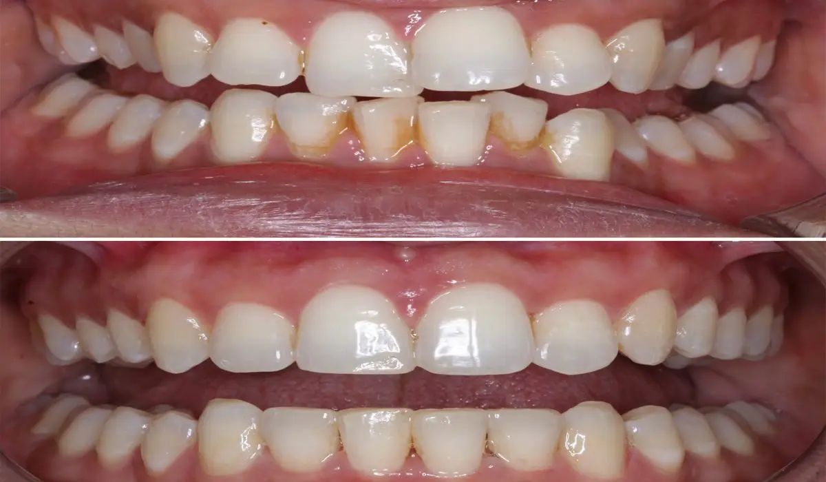 before and after photo of teeth after complete dental care