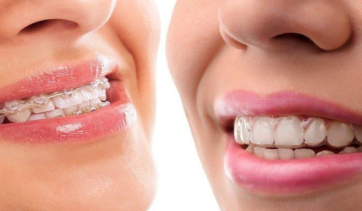 One girl is wearing Invisalign, while the other is wearing braces.