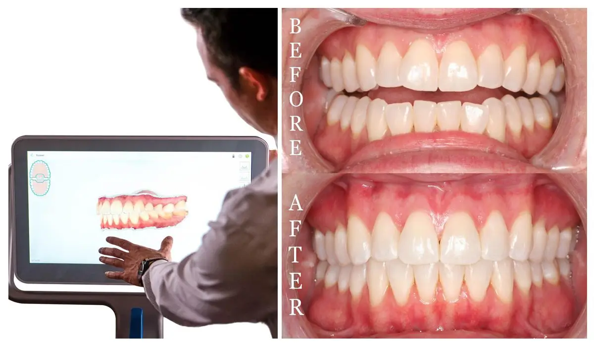 before and after photo of the effect of teeth whitening