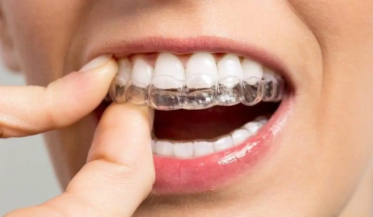 A woman's hand putting Invisalign aligner into teeth..