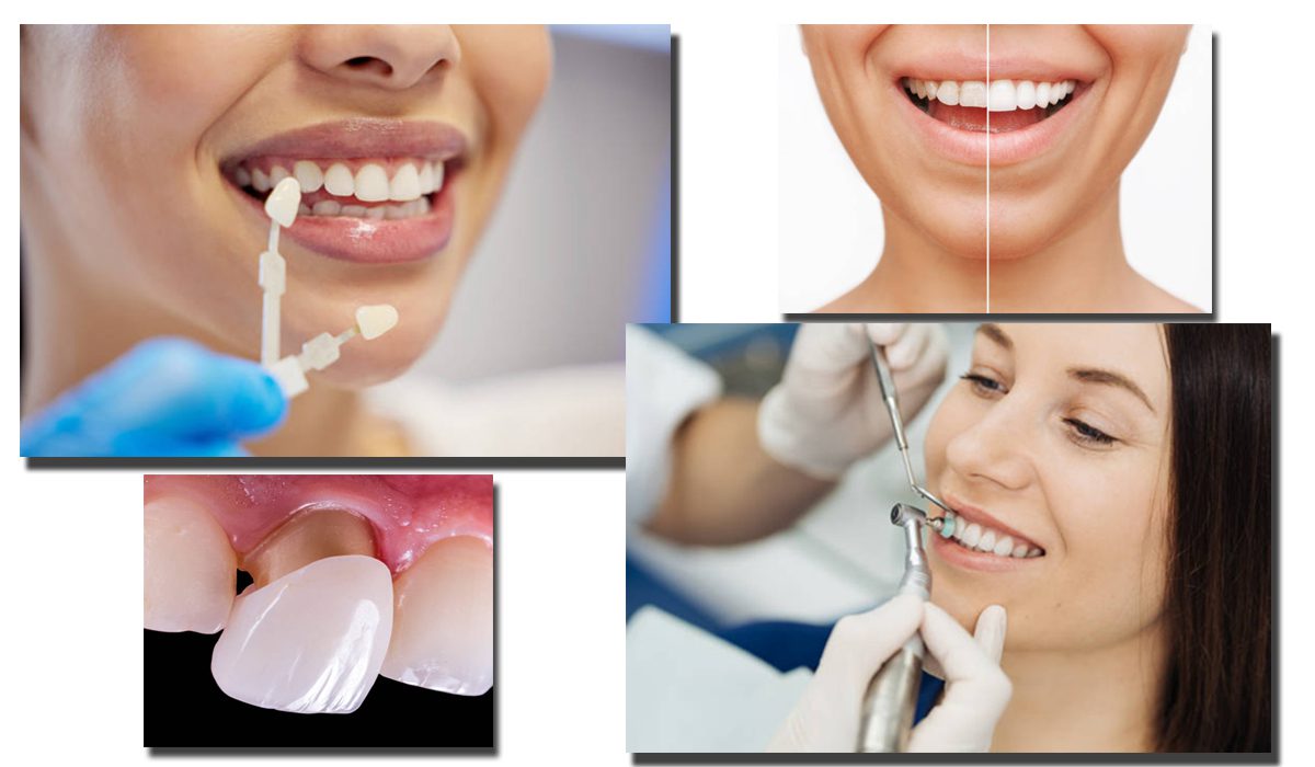 Schaumburg Dentistry: Achieve A Radiant Smile With Dental Veneers