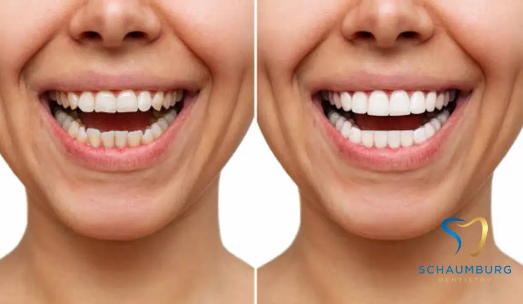 Teeth comparison of a woman. Teeth whitening at Schaumburg.