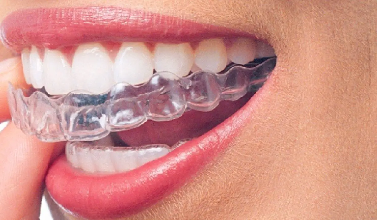 woman putting clear aligners to teeth