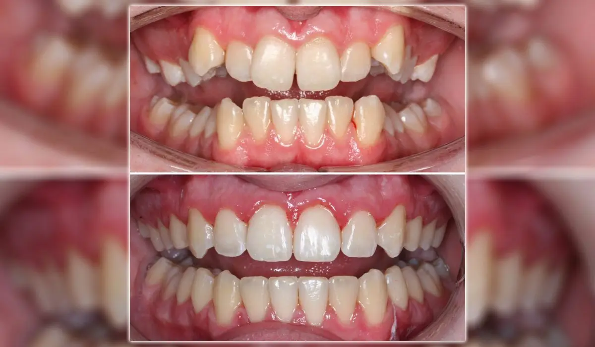 Invisalign Before And After: Real Transformations 