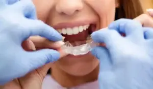 dentist putting on celar aligners on woman
