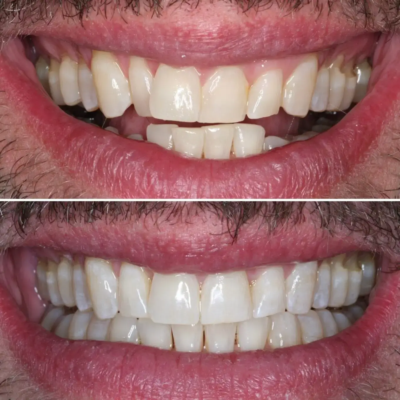Transform Your Smile: Invisalign Before And After
