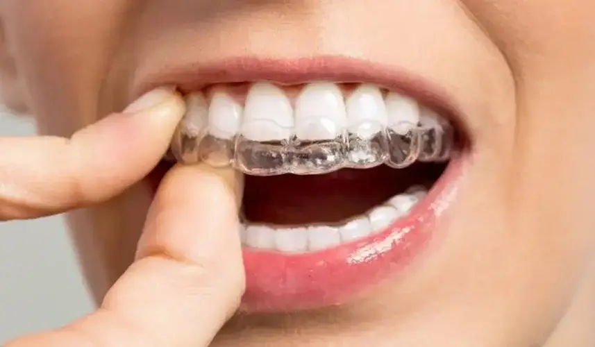 woman putting on clear aligners