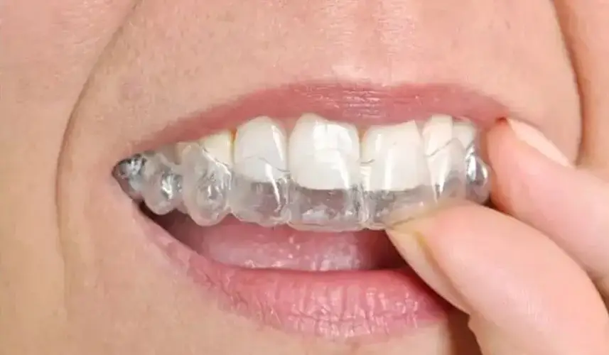 Invisalign in Schaumburg: A Seamless Path to Straighter Teeth