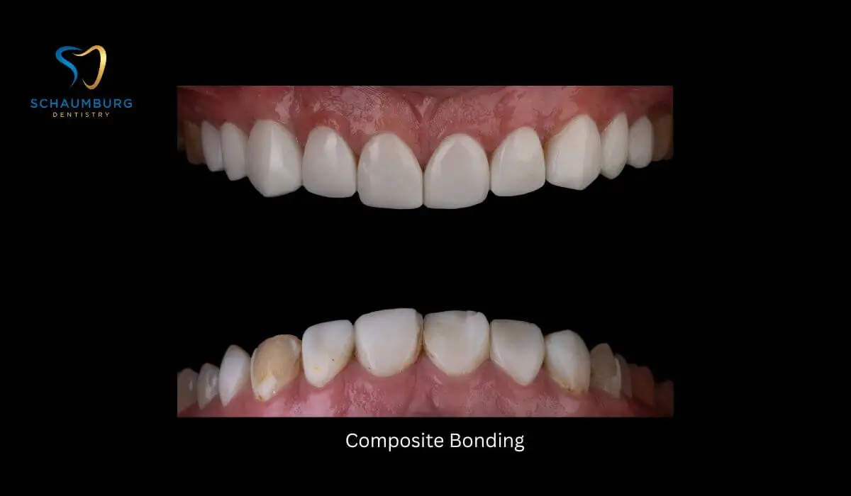 Before and after photos of teeth treated with composite bonding at Schaumburg Dentistry, showing improvement in tooth color and alignment.
