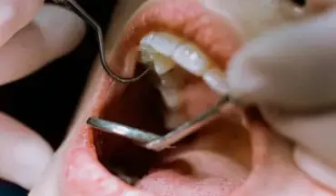 Close-up of a patient receiving a root canal treatment at Schaumburg Dentistry