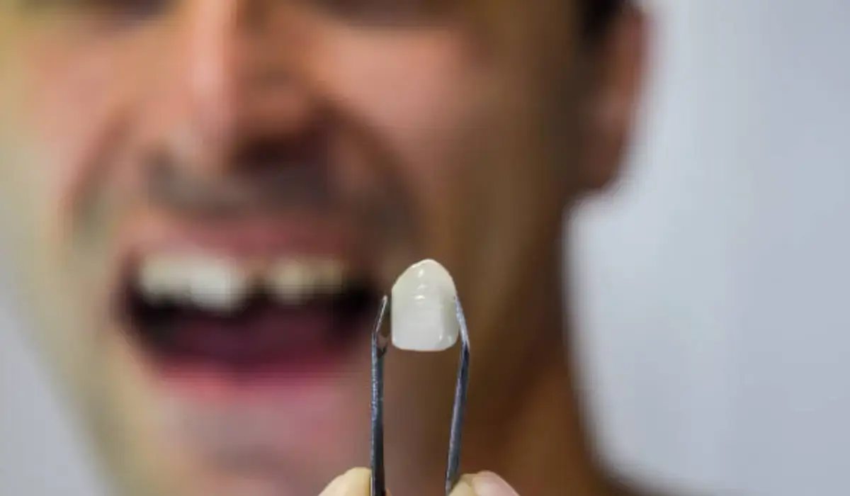 Close-up of a knocked-out tooth being held with tweezers, highlighting proper handling for preservation.