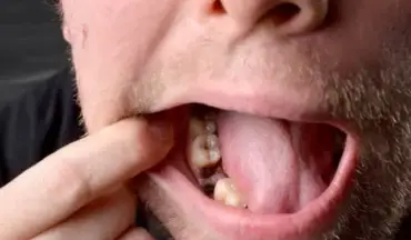 A person pulling back their cheek to reveal a dry socket after tooth extraction, with exposed gum and bone.