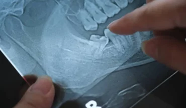 A dentist’s finger pointing at an X-ray of an impacted wisdom tooth, indicating the need for removal.