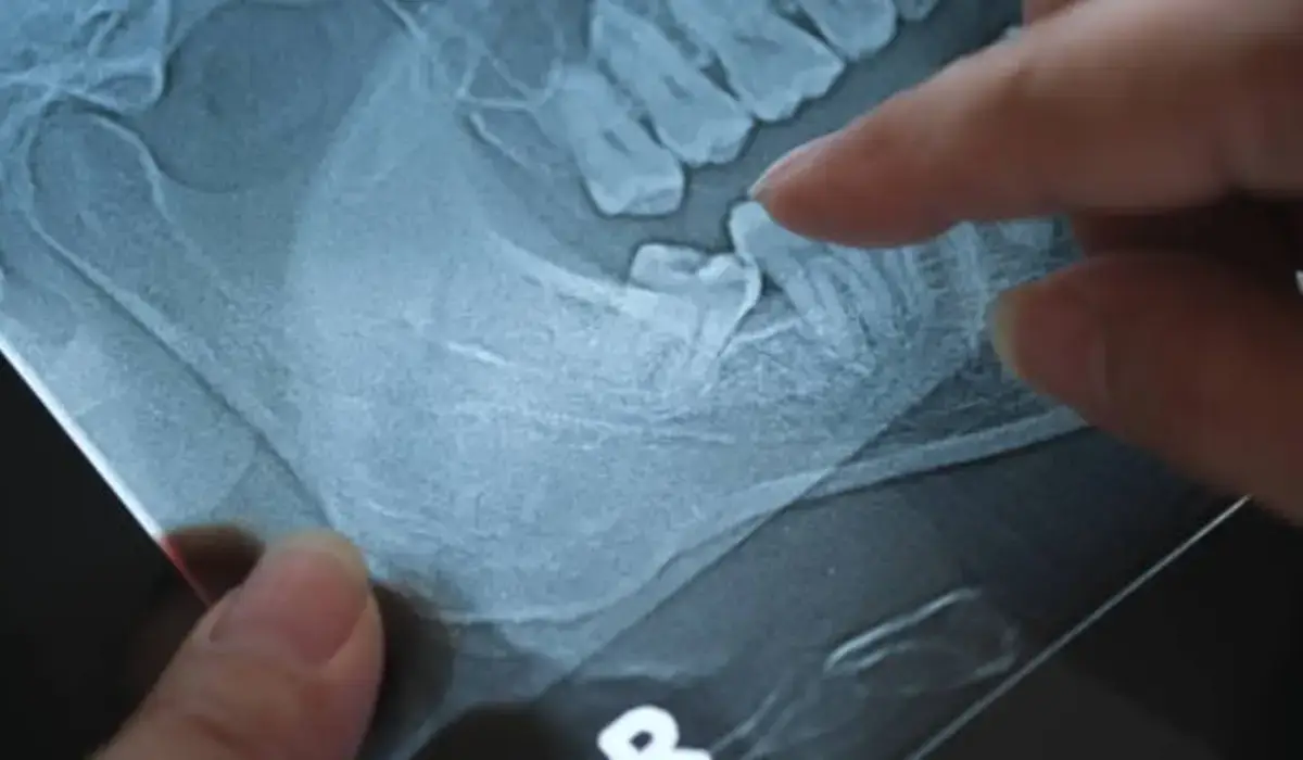 A dentist’s finger pointing at an X-ray of an impacted wisdom tooth, indicating the need for removal.