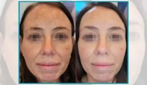 Before and after skin treatment showing results of Opus Plasma vs. Laser Resurfacing for facial rejuvenation.