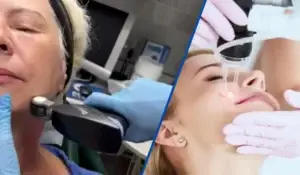 Split image comparing Opus Plasma vs. Laser Skin Resurfacing facial treatments performed by professionals on patients' skin.