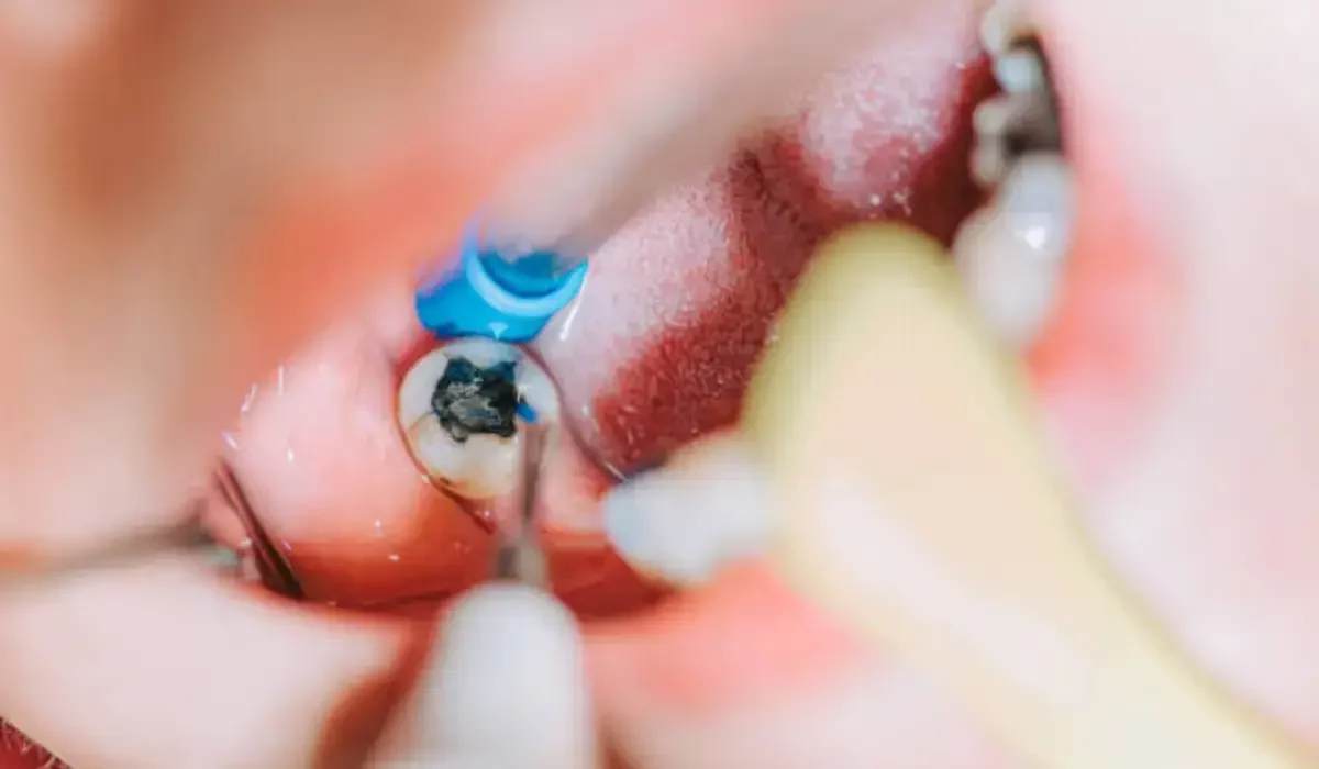 Close-up of a root canal procedure at Schaumburg Dentistry, showing precision dental care.